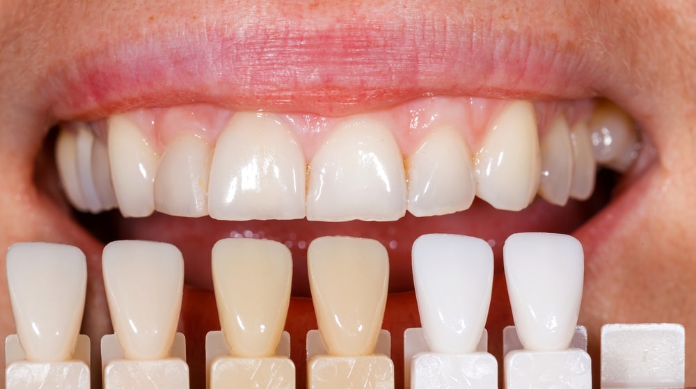ציפויי שיניים
